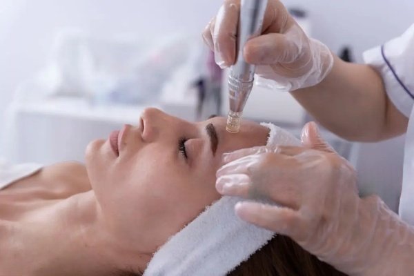 Scottsdale Micro Needling